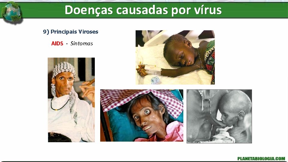 Doenças causadas por vírus 9) Principais Viroses AIDS - Sintomas 