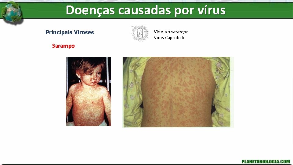Doenças causadas por vírus Principais Viroses Sarampo Vírus do sarampo Vírus Capsulado 