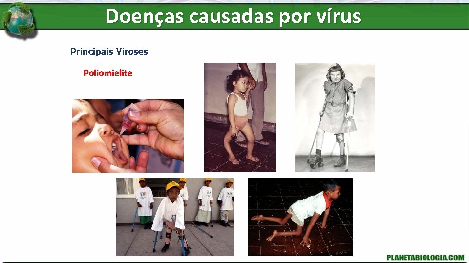 Doenças causadas por vírus Principais Viroses Poliomielite 