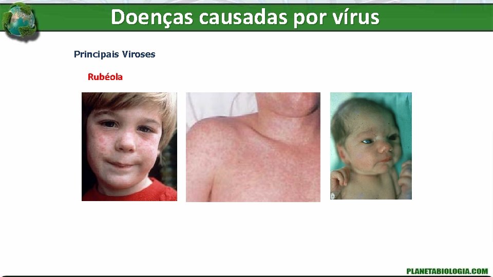 Doenças causadas por vírus Principais Viroses Rubéola 