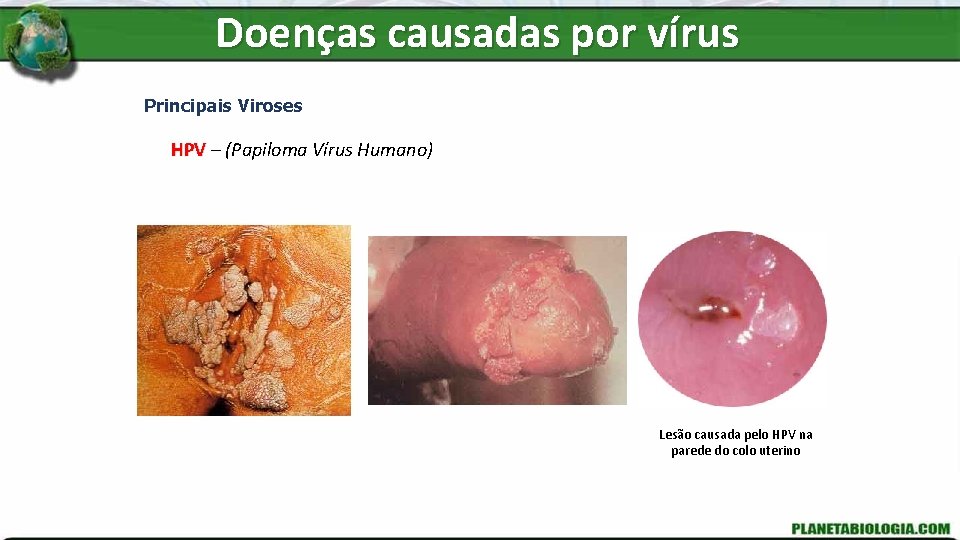 Doenças causadas por vírus Principais Viroses HPV – (Papiloma Vírus Humano) Lesão causada pelo