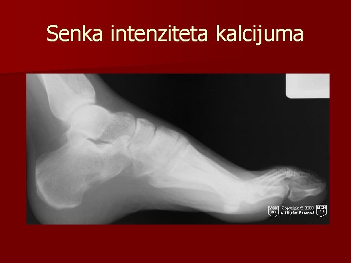 Senka intenziteta kalcijuma 