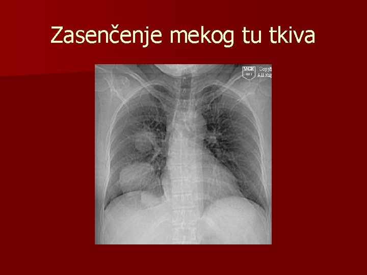 Zasenčenje mekog tu tkiva 