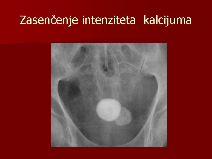 Zasenčenje intenziteta kalcijuma 