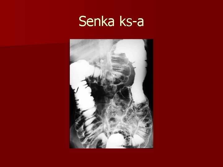 Senka ks-a 