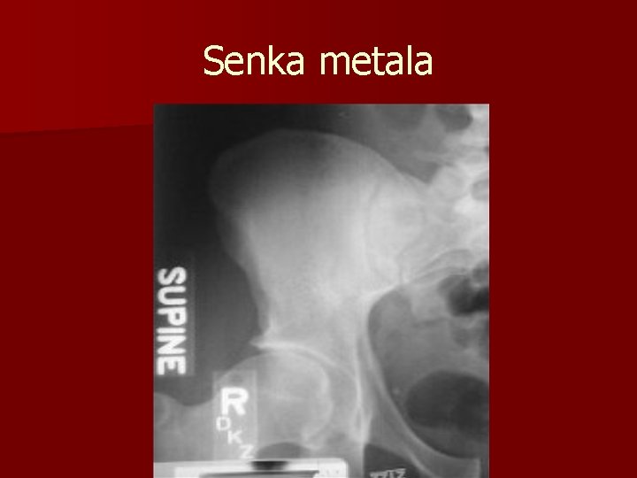 Senka metala 
