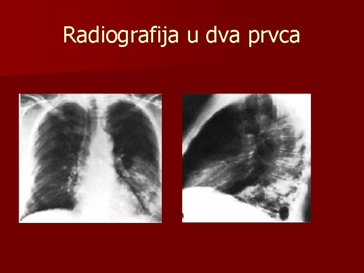 Radiografija u dva prvca 