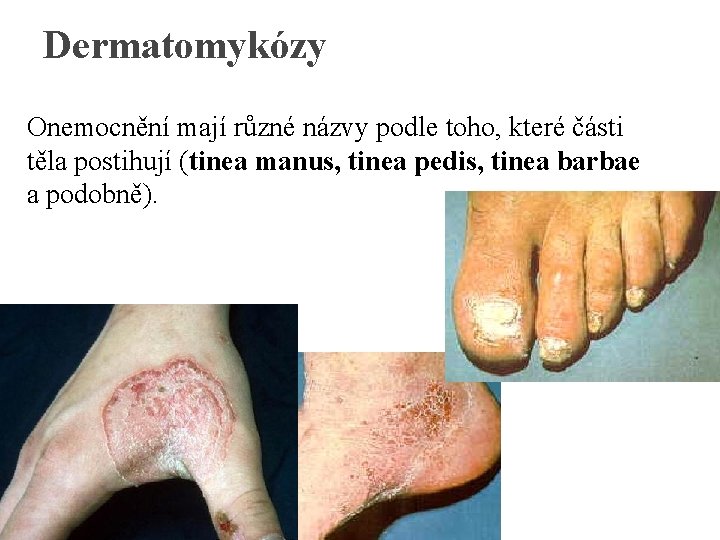 Dermatomykózy Onemocnění mají různé názvy podle toho, které části těla postihují (tinea manus, tinea