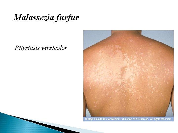 Malassezia furfur Pityriasis versicolor 