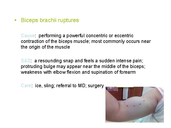  • Biceps brachii ruptures Cause: performing a powerful concentric or eccentric contraction of