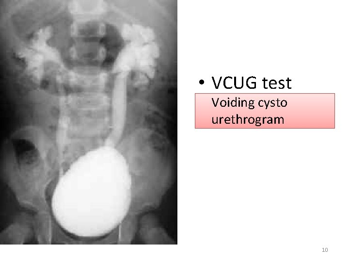  • VCUG test Voiding cysto urethrogram 10 