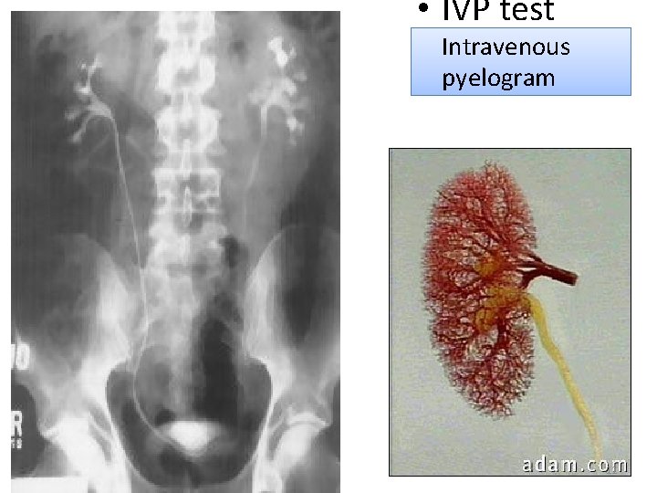  • IVP test Intravenous pyelogram 11 