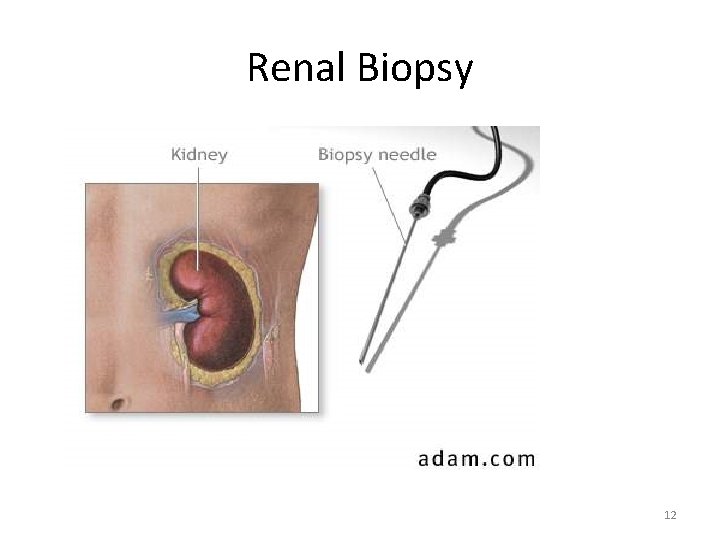 Renal Biopsy 12 