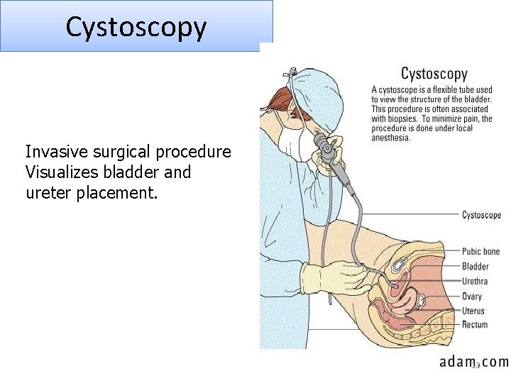 Cystoscopy Invasive surgical procedure Visualizes bladder and ureter placement. 13 