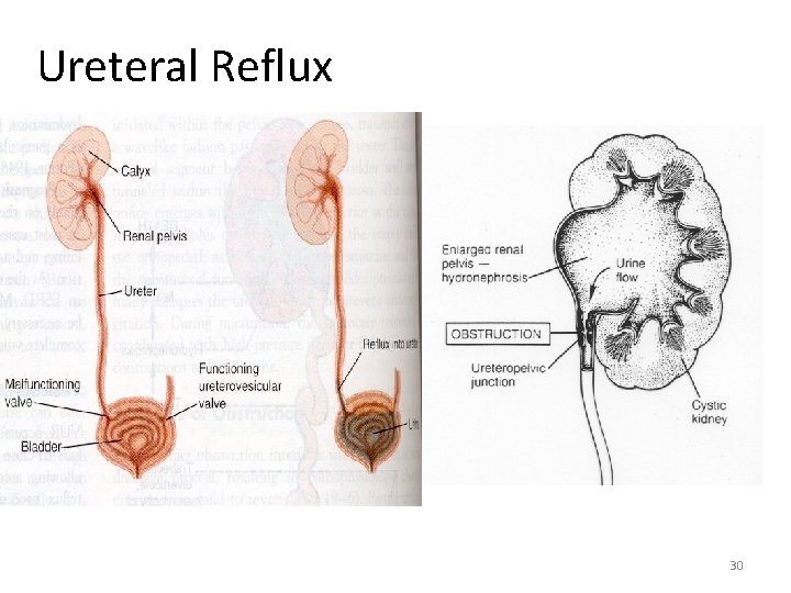 Ureteral Reflux 30 