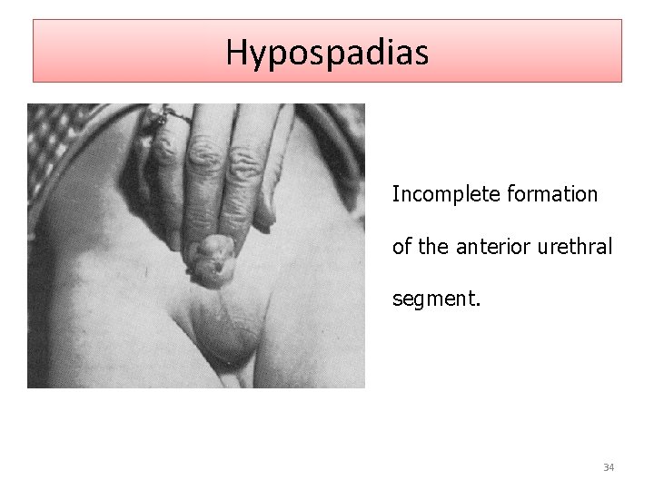 Hypospadias Incomplete formation of the anterior urethral segment. 34 