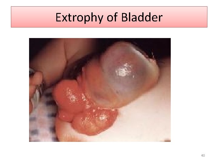 Extrophy of Bladder 40 