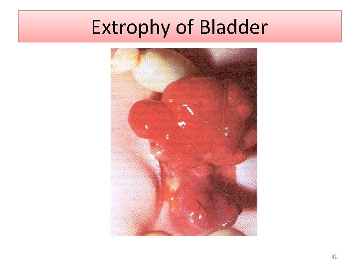 Extrophy of Bladder 41 