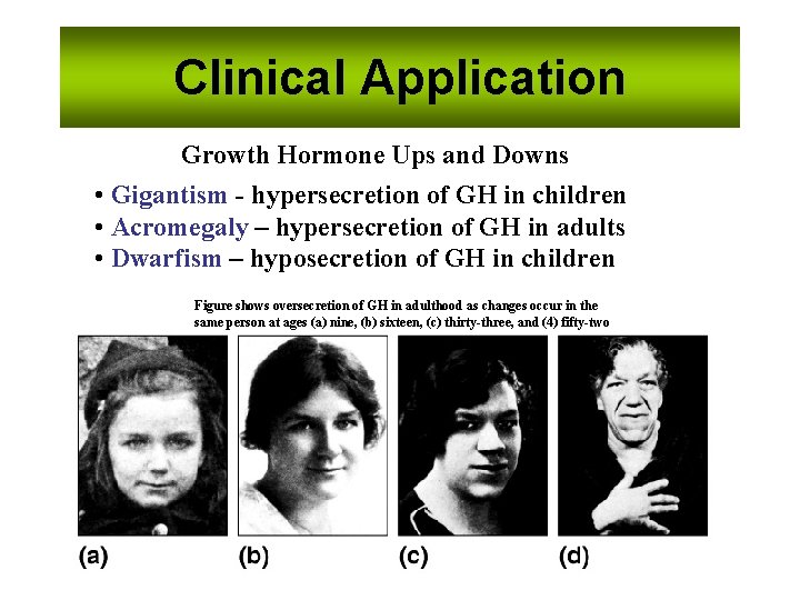 Clinical Application Growth Hormone Ups and Downs • Gigantism - hypersecretion of GH in