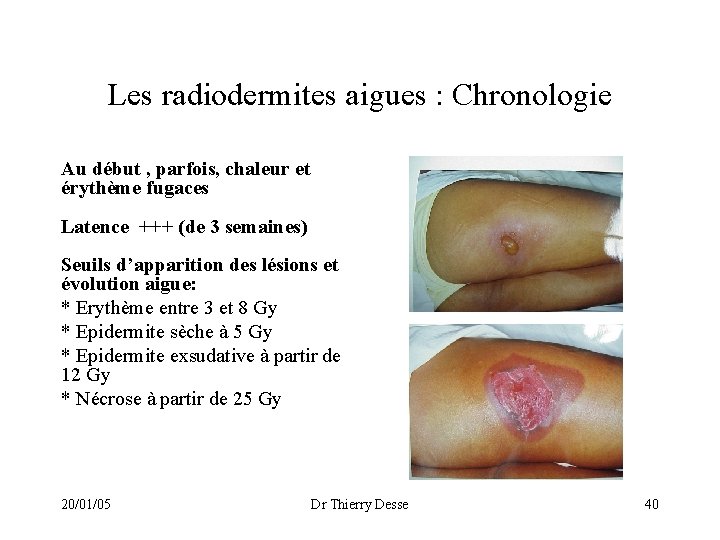 Les radiodermites aigues : Chronologie Au début , parfois, chaleur et érythème fugaces Latence