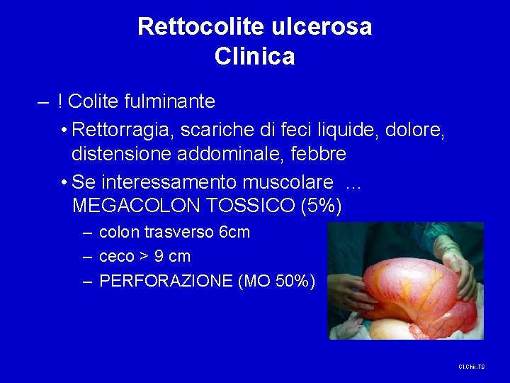 Rettocolite ulcerosa Clinica – ! Colite fulminante • Rettorragia, scariche di feci liquide, dolore,