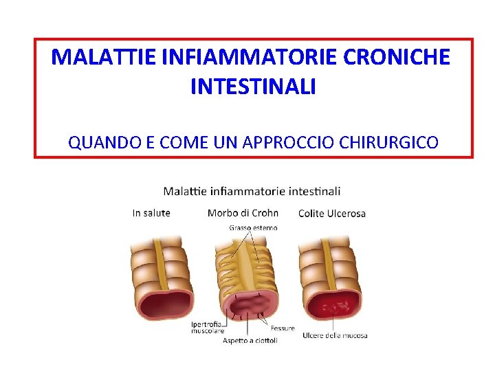 MALATTIE INFIAMMATORIE CRONICHE INTESTINALI QUANDO E COME UN APPROCCIO CHIRURGICO 