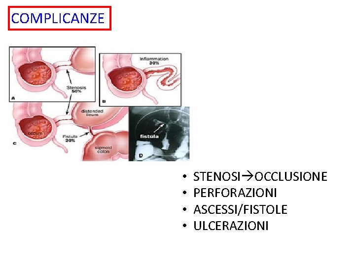 COMPLICANZE • • STENOSI OCCLUSIONE PERFORAZIONI ASCESSI/FISTOLE ULCERAZIONI 