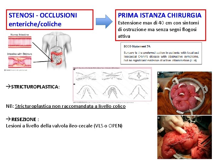 STENOSI - OCCLUSIONI enteriche/coliche PRIMA ISTANZA CHIRURGIA Estensione max di 40 cm con sintomi