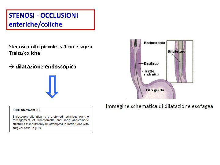 STENOSI - OCCLUSIONI enteriche/coliche Stenosi molto piccole < 4 cm e sopra Treitz/coliche dilatazione