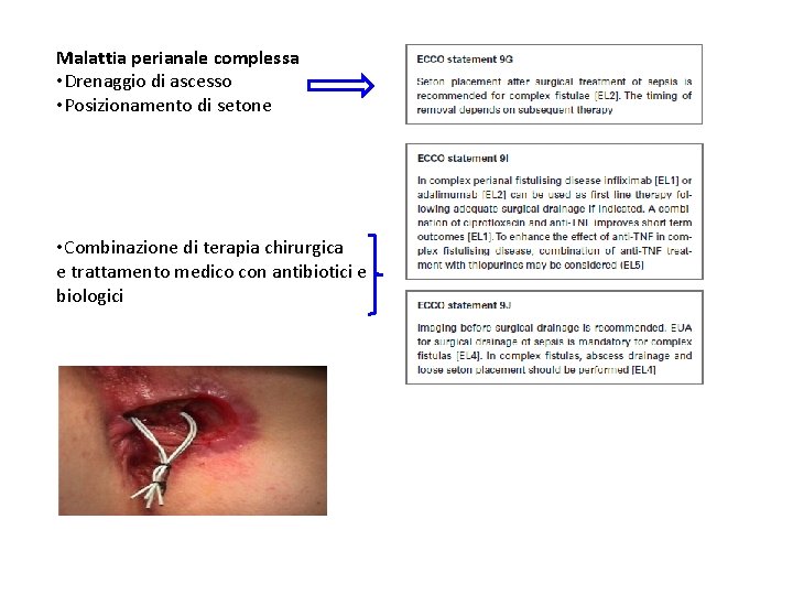 Malattia perianale complessa • Drenaggio di ascesso • Posizionamento di setone • Combinazione di