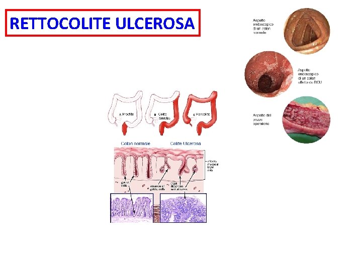 RETTOCOLITE ULCEROSA 