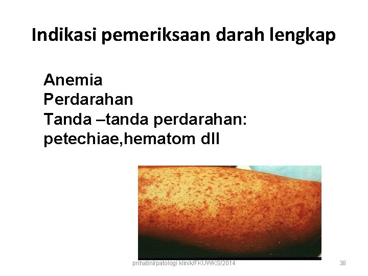 Indikasi pemeriksaan darah lengkap Anemia Perdarahan Tanda –tanda perdarahan: petechiae, hematom dll prihatini/patologi klinik/FKUWKS/2014 Indikasi pemeriksaan darah lengkap Anemia Perdarahan Tanda –tanda perdarahan: petechiae, hematom dll prihatini/patologi klinik/FKUWKS/2014