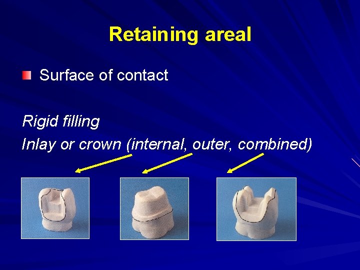 Retaining areal Surface of contact Rigid filling Inlay or crown (internal, outer, combined) 