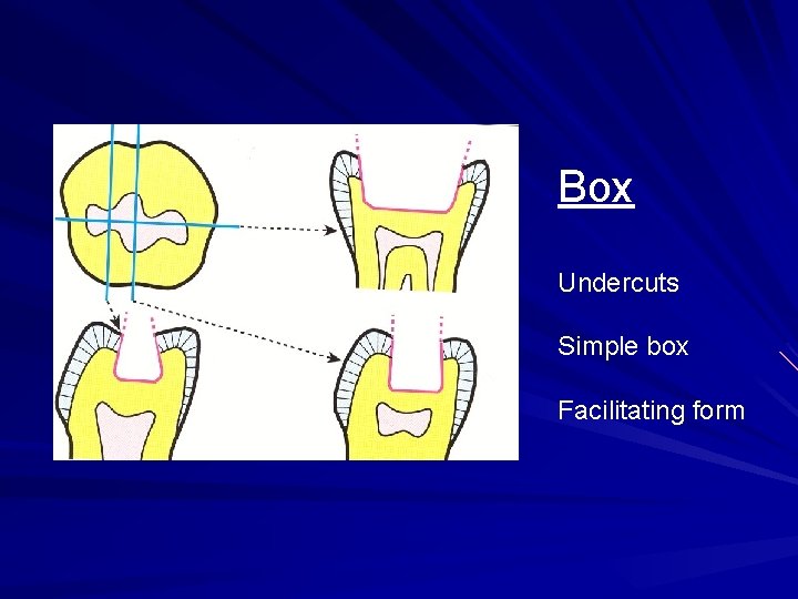 Box Undercuts Simple box Facilitating form 