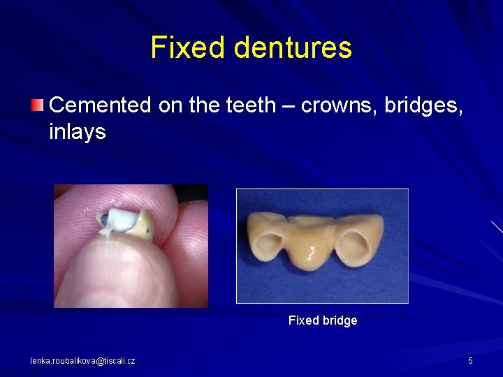 Fixed dentures Cemented on the teeth – crowns, bridges, inlays Fixed bridge lenka. roubalikova@tiscali.