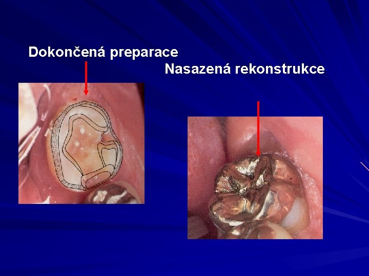 Dokončená preparace Nasazená rekonstrukce 