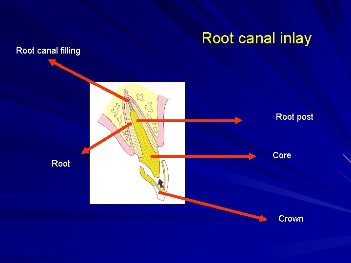 Root canal filling Root canal inlay Root post Root Core Crown 