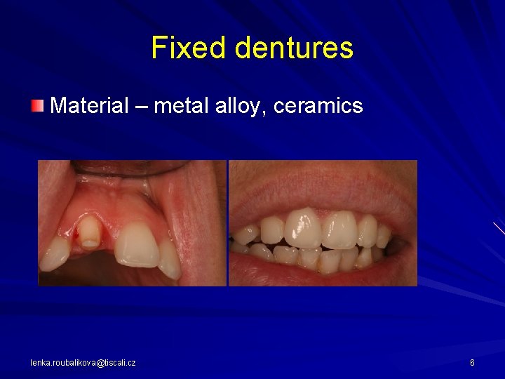 Fixed dentures Material – metal alloy, ceramics lenka. roubalikova@tiscali. cz 6 