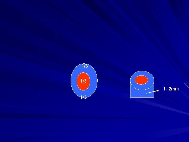 1/3 1 - 2 mm 1/3 