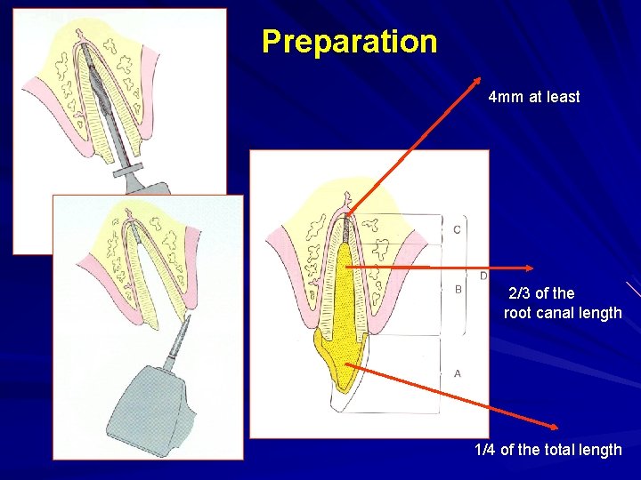 Preparation 4 mm at least 2/3 of the root canal length 1/4 of the