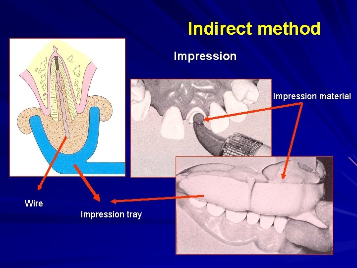 Indirect method Impression material Wire Impression tray 