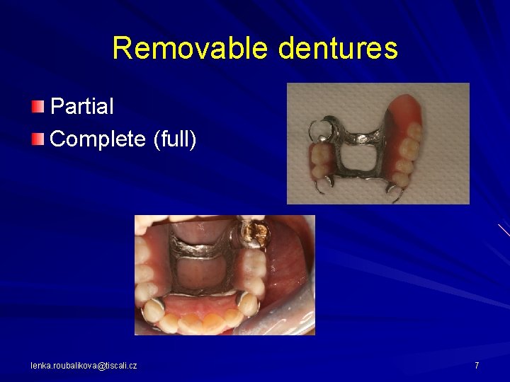 Removable dentures Partial Complete (full) lenka. roubalikova@tiscali. cz 7 