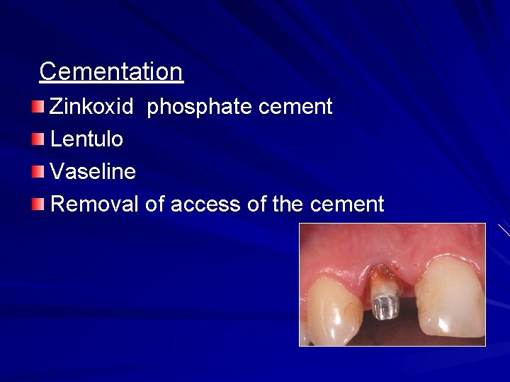 Cementation Zinkoxid phosphate cement Lentulo Vaseline Removal of access of the cement 