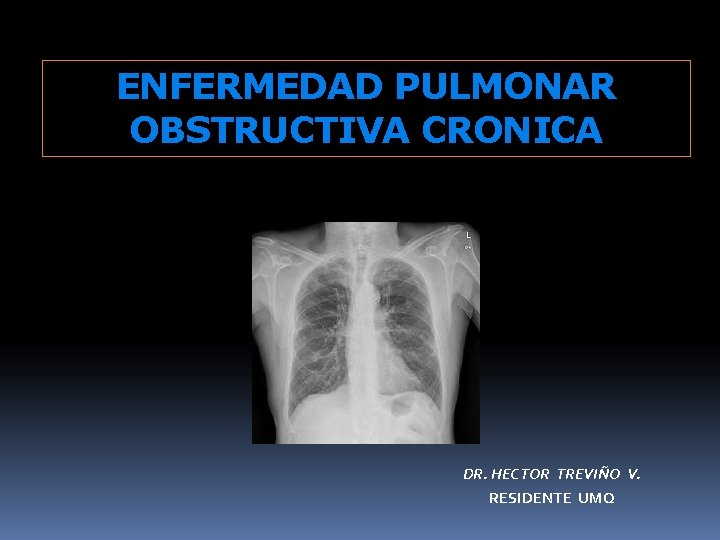 ENFERMEDAD PULMONAR OBSTRUCTIVA CRONICA DR. HECTOR TREVIÑO V. RESIDENTE UMQ 