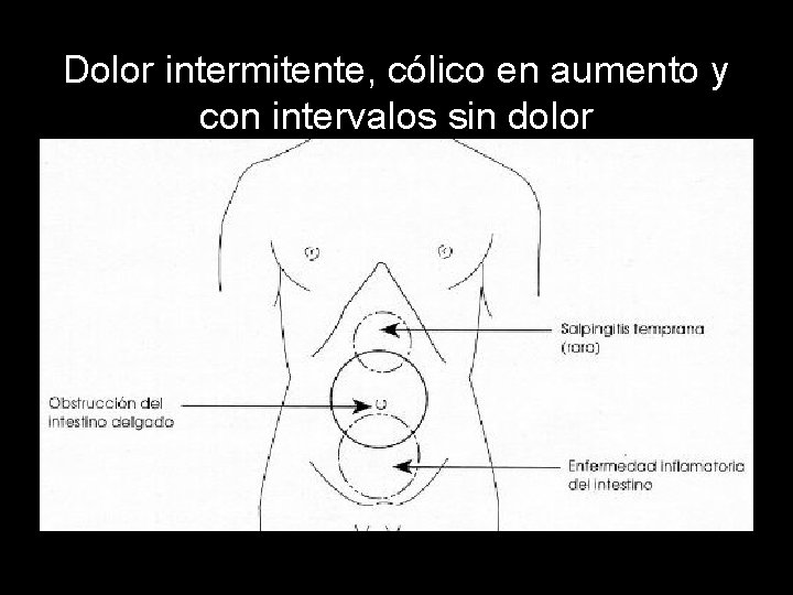 Dolor intermitente, cólico en aumento y con intervalos sin dolor 