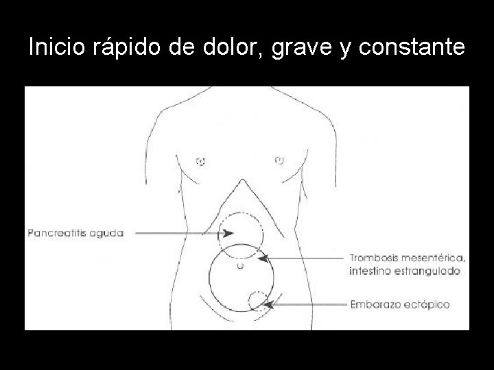 Inicio rápido de dolor, grave y constante 