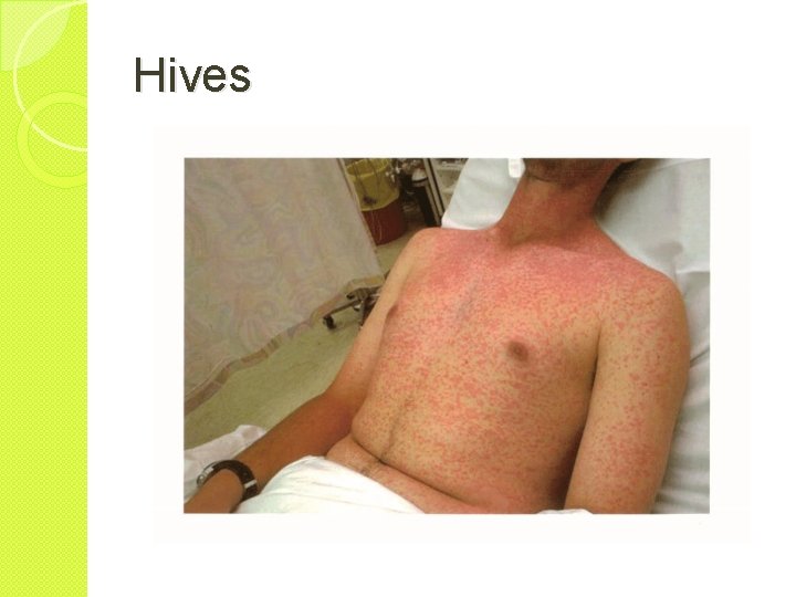 Hives 