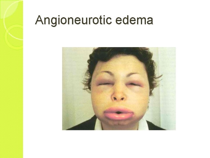 Angioneurotic edema 