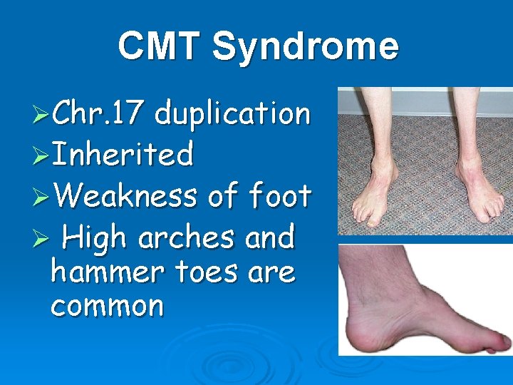 CMT Syndrome ØChr. 17 duplication ØInherited ØWeakness of foot Ø High arches and hammer