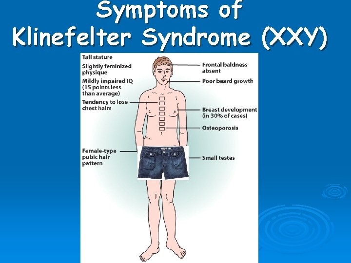 Symptoms of Klinefelter Syndrome (XXY) 